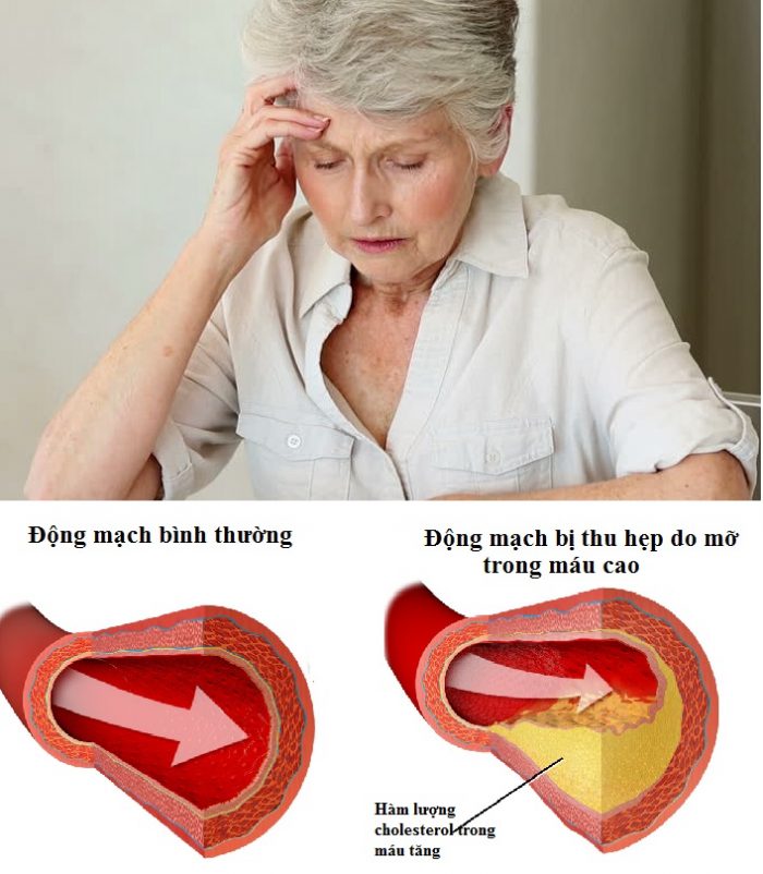 Mõ trong máu cao uống thuốc gì tốt nhất hiện nay